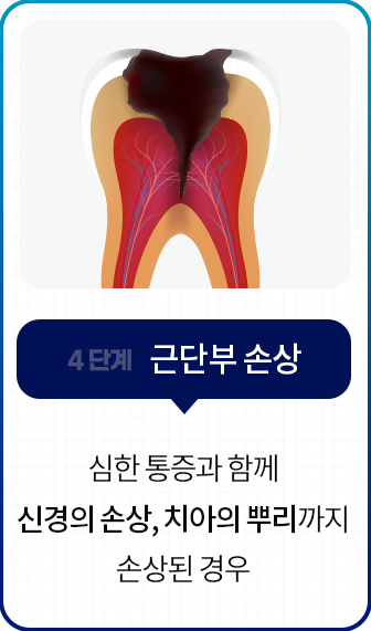 4단계-근단부-손상-심한-통증과-함께-신경의-손상-치아의-뿌리까지-손상된-경우