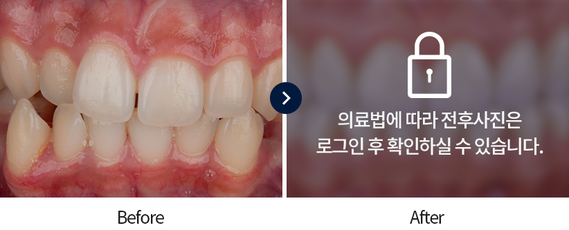 치아교정-전후사진5