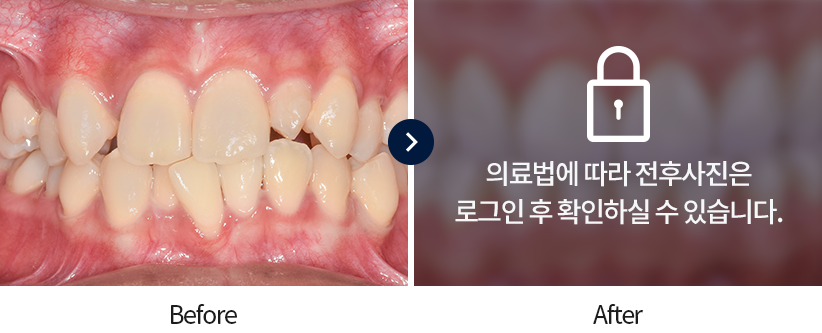 치아교정-전후사진4